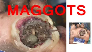 #Maggots Gangrene Foot Before After Video