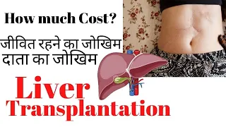 Liver transplantation cost, survival rate and donor risk | Liver transplant kitna success hai