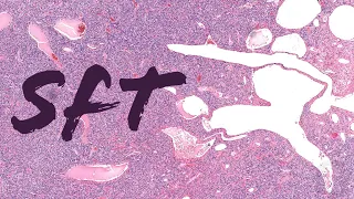 Solitary fibrous tumor (formerly: hemangiopericytoma) staghorn vessels soft tissue tumor pathology