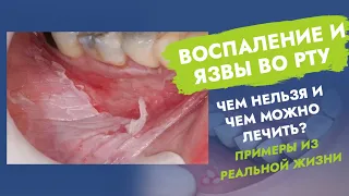 Воспаление во рту. Язвы во рту. Чем нельзя и чем можно лечить?