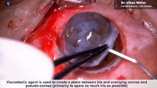 Penetrating Keratoplasty in Anterior Staphyloma | Cornea Colours | Season-2 | Ep-1