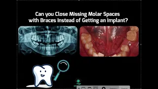 Is it Possible to Close Missing Molar Spaces with Invisalign or Braces?