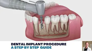 Dental Implant Procedure: A Step by Step Guide