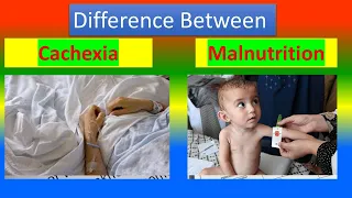 Difference between  Cachexia and Malnutrition