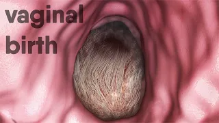 vaginal birth-natural childbirth