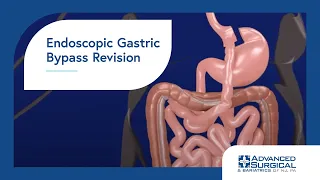 Endoscopic Gastric Bypass Revision
