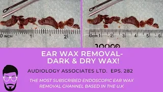 DARK DRY EAR WAX REMOVAL - EP 282