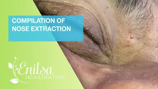 Christmas Compilation of Nose Extraction