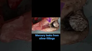 Mercury leaks from amalgam fillings into blood supply