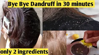 DIY. Dandruff treatment at home in 30 minutes only with 2 ingredients|Bye Bye Dandruff in 1 wash