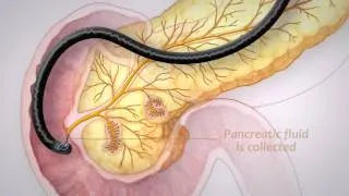 Pancreatic Cancer Screening