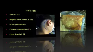 The transcondylar approach to craniocervical meningiomas