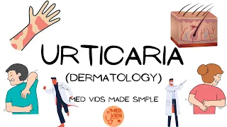 Urticaria | Dermatology (Pathophysiology,clinical features,diagnosis,treatment) MedVidsMadeSimple