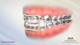 Orthodontic Treatment for Openbite - Rubber Bands