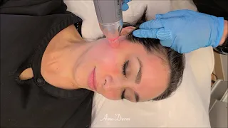 Radiofrequency Microneedling - RF Microneedling Treatment