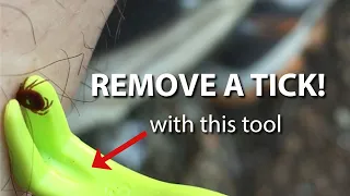 REMOVE TICKS EASY with a removal tool while lowering the chances of disease.