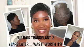 FUE Hair transplant 2 YEARS LATER ((Things I Now Know))