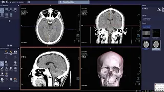 فحص الأشعة المقطعية على المخ بدون صبغة CT BRAIN