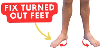 Fix TURNED OUT Feet with Two Easy Exercises (duck feet)
