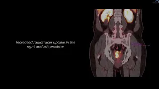 PSMA PET CT and MRI Prostate Cancer