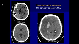 Костеников А.Н.«Неотложная КТ, МРТ, ЦАГ ишемического инсульта в условиях сосудистого центра»