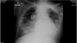 chest film reading dr  hassan el kiki