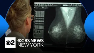 New guidelines recommend women start breast cancer screenings at age 40