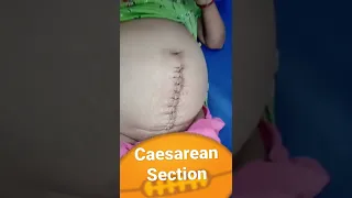 CAESAREAN SECTION||POST DELIVERY PATIENT||DR.ABUL HUSSAIN