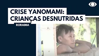 Crise Yanomami: crianças desnutridas