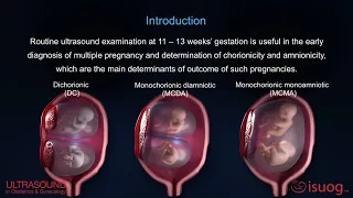 UOG video abstract: Outcome of twin pregnancy with two live fetuses at 11–13 weeks’ gestation