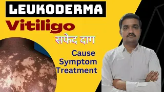 leucoderma ( vitiligo ) - causes, symptoms, treatment | सफेद दाग | msn| nursing lecture in hindi