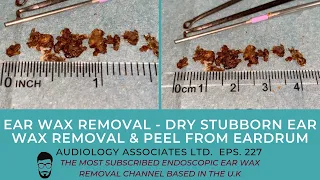 EAR WAX REMOVAL - DRY STUBBORN EAR WAX REMOVAL & PEEL FROM EARDRUM - EP 227