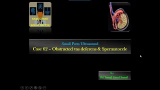 Ultrasound Case 62 - Dilated Vas Deferens and .... (Infertility Scan)