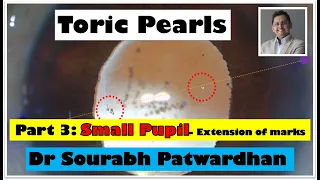 Toric IOL pearl 3: Small Pupil -IOL mark extension Dr Sourabh Patwardhan