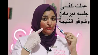 عملت لنفسى جلسه ديرمابن وشوفو النتيجة