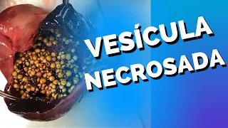 VESÍCULA BILIAR NECROSADA, vesícula biliar estourou e agora ?