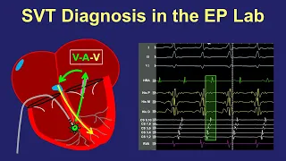 Diagnosis of SVT in the EP lab