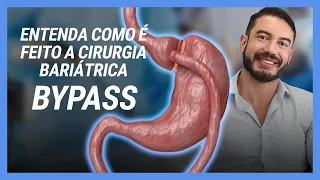Entenda como é feito a Cirurgia Bariátrica BYPASS  - Dr. Leonardo Fiuza