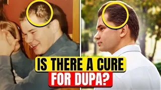 How Do You Fix Thinning Hair On The Sides (DUPA)?