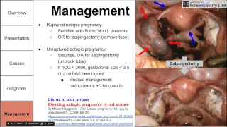 Ectopic pregnancy