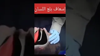 إسعاف بلع اللسان Tongue swallowing first aid