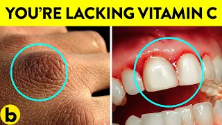 Signs Your Body Is Lacking Vitamin C & Its Benefits