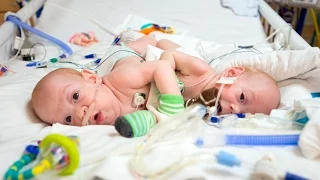 Rare Conjoined Twins Successfully Separated by Nemours Surgeons at Wolfson Children's Hospital