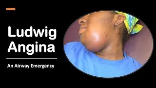 Ludwig Angina: An Airway Emergency