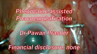 Phenocaine assisted Phacoemulsification