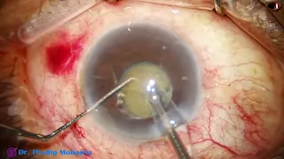 CATARACT WITH PHACOLYTIC GLAUCOMA, See postop pictures at the end - Pradip Mohanta, May 2024