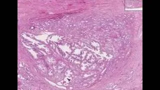 Histopathology Prostate--Adenocarcinoma Gleason (grade 1)