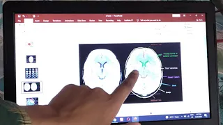 CT scan BRAIN important lesions at a single place in easiest way, exam revision part 1