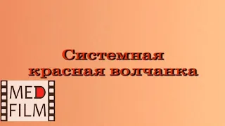 Системная красная волчанка © Systemic lupus erythematosus