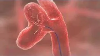 Aneurysm Coiling Animation